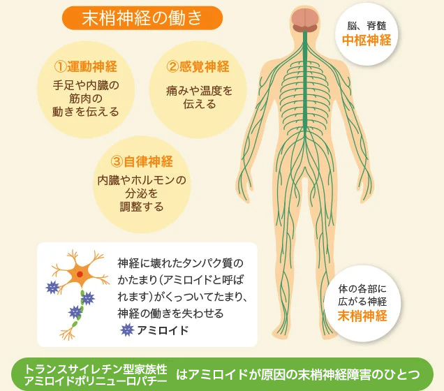 トランスサイレチン型家族性アミロイドポリニューロパチーはアミロイドが原因の末梢神経障害のひとつです。